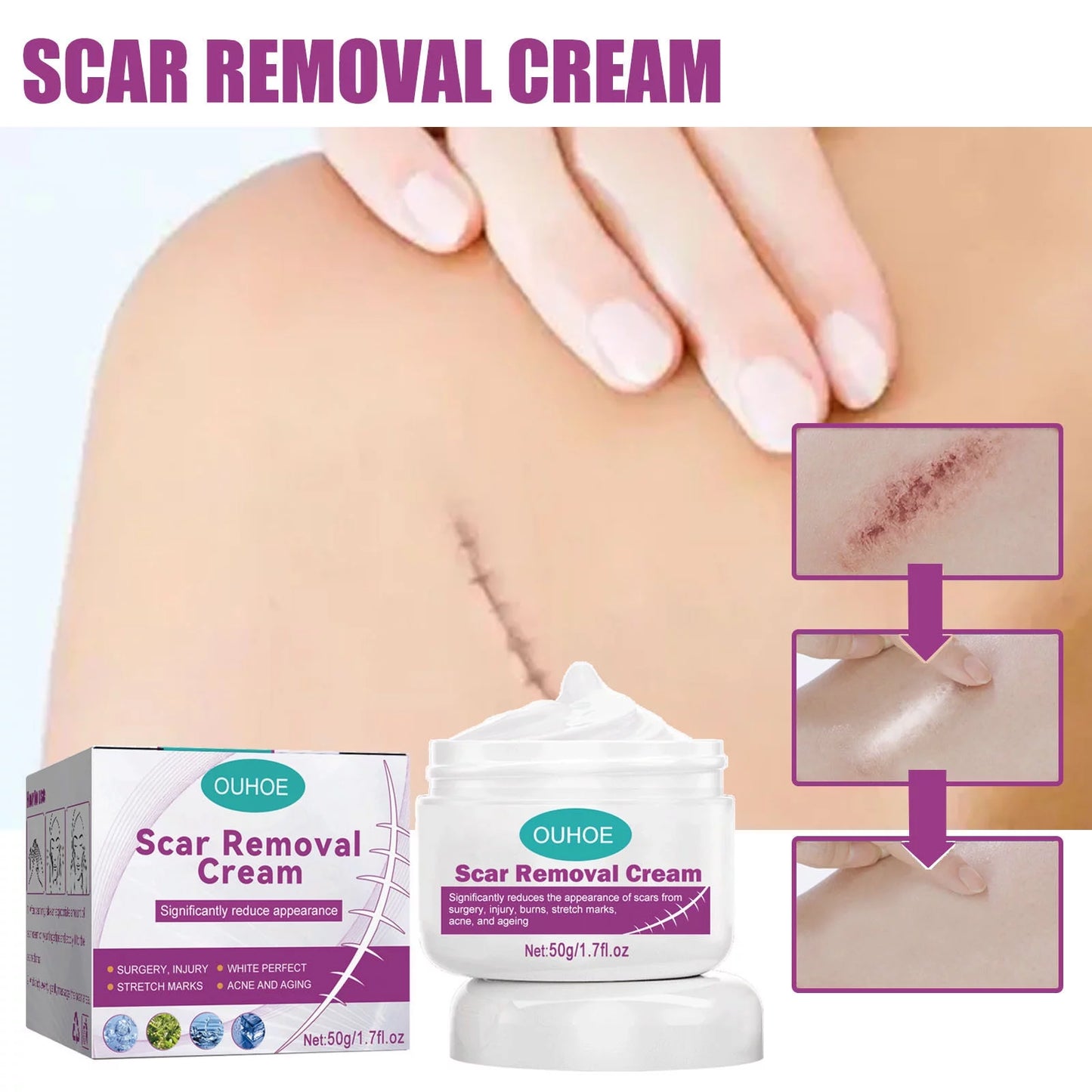 Cream Removal Cream 2PCS Scar 50ml and Repair Removal Repair Scar Scar Skin